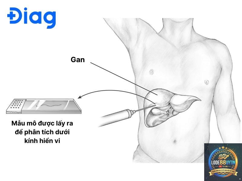 đề gan là gì - Image 3