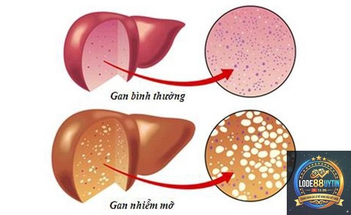 đề gan là gì - Image 4